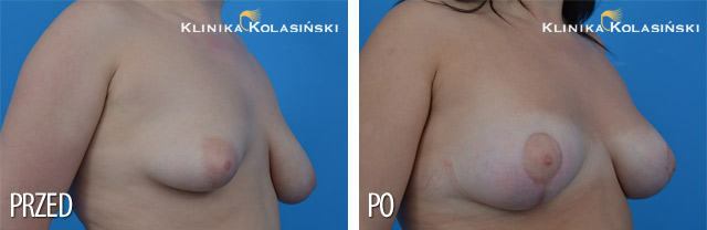 Zdjęcia przed i po - Podniesienie piersi