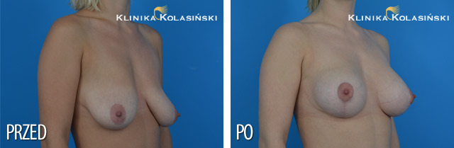 Zdjęcia przed i po - Podniesienie piersi