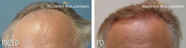 Przeszczep włosów - zdjęcia przed i po - Liczba przeszczepionych zespołów mieszkowych: 1100