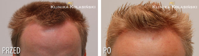 Przeszczep włosów - zdjęcia przed i po - Liczba przeszczepionych zespołów mieszkowych: 1200