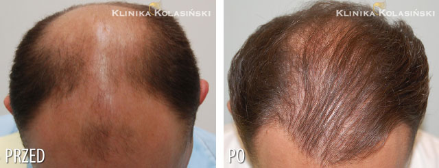 Przeszczep włosów - zdjęcia przed i po - Liczba przeszczepionych zespołów mieszkowych: 1510