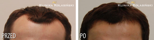 Przeszczep włosów - zdjęcia przed i po - Liczba przeszczepionych zespołów mieszkowych: 1800