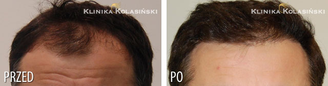 Przeszczep włosów - zdjęcia przed i po - Liczba przeszczepionych zespołów mieszkowych: 2700