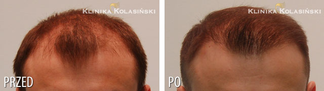 Przeszczep włosów - zdjęcia przed i po - Liczba przeszczepionych zespołów mieszkowych: 3050