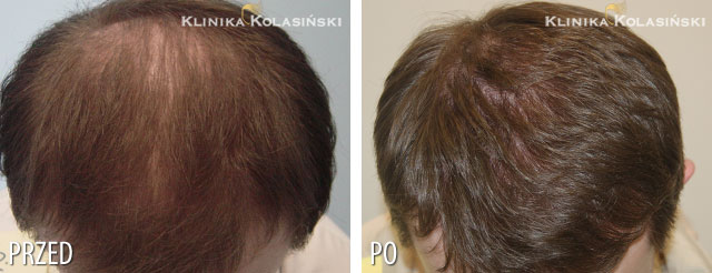 Przeszczep włosów - zdjęcia przed i po - Liczba przeszczepionych zespołów mieszkowych: 3800