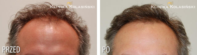 Przeszczep włosów - zdjęcia przed i po - Liczba przeszczepionych zespołów mieszkowych: 4450