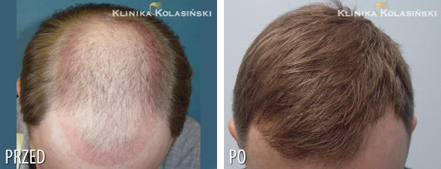 Pictures before and after: hair transplant