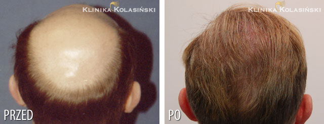 Przeszczep włosów - zdjęcia przed i po - Liczba przeszczepionych zespołów mieszkowych: 5230