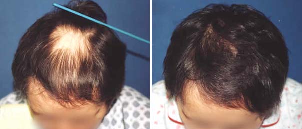 Natalia przed i po zabiegu przeszczepu włosów