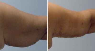Widoczna zwisająca skóra ramienia u pacjęta 46-letniego po utracie znacznej masy ciała. Stan przed leczeniem oraz Stan bezpośrednio po operacji