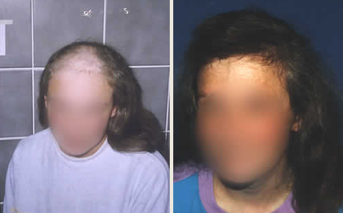 Pacjentka lat 40 z rozległum łysieniem pourazowym okolicy czołowej i ciemieniowej. Ta sama pacjentka po 2 zabiegach przeszczepu włosów - włosy obficie rozną.