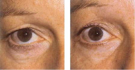 Oprawa oczu przed i po korekcji powiek górnych
