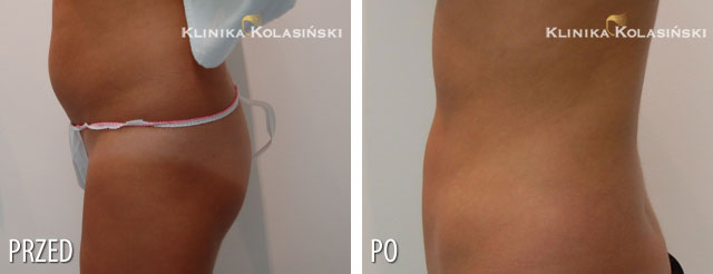 Pictures before and after: Liposuction