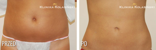 Bilder vorher und nachher: Liposuction