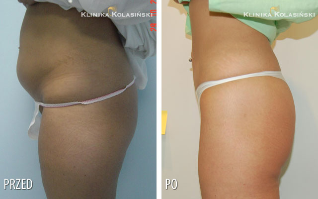 Pictures before and after: Liposuction