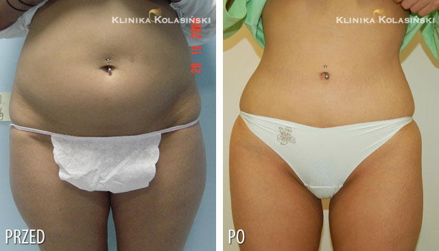 Pictures before and after: Liposuction