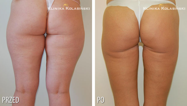 Zdjęcia przed i po: Liposukcja