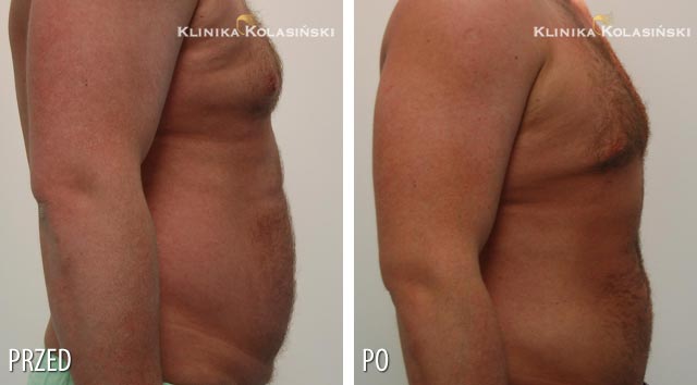 Zdjęcia przed i po: Liposukcja
