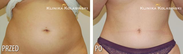 Pictures before and after: Liposuction