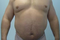 Typ jabłkowy otyłości występujący głównie u mężczyzn. Widoczna znaczna otyłość okolic brzucha i talii.