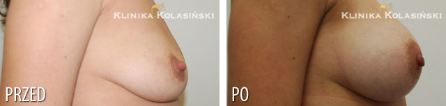 Bilder vorher und nachher: Bruststraffung mf295g