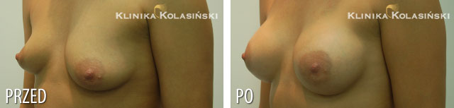Bilder vorher und nachher: Bruststraffung