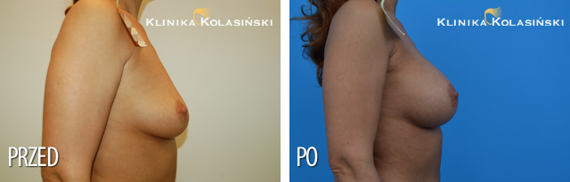 Zdjęcia przed i po: Powiększanie piersi 