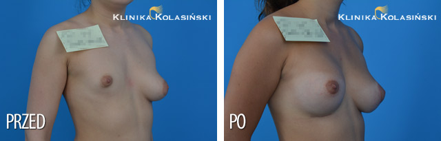 Zdjęcia przed i po: Powiększanie piersi