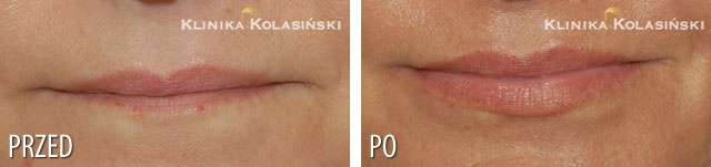 Bilder vorher und nachher: Lippenkorrektur