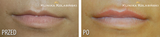 Zdjęcia przed i po: Powiększanie ust