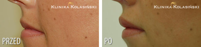 Bilder vorher und nachher: Lippenkorrektur