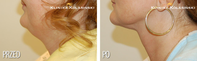 Liposukcja podbródka - zdjęcia przed i po