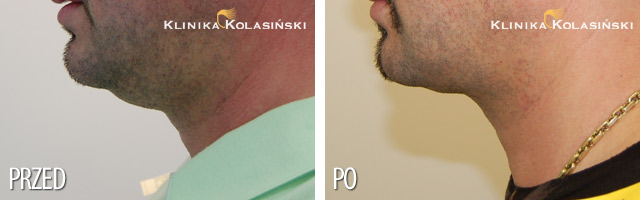 Liposukcja podbródka - zdjęcia przed i po