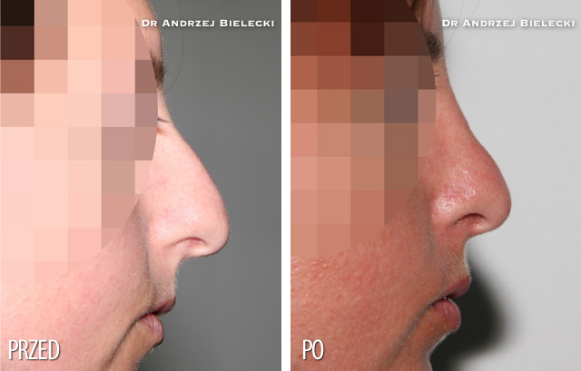 Korekcja nosa - zdjecia przed i po