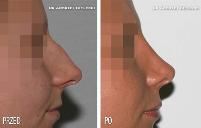 Korekcja nosa - zdjecia przed i po