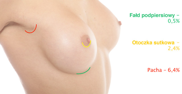 Wpływ lokalizacji cięcia na ryzyko rozwoju torebki włóknistej dookoła implantu piersiowego
