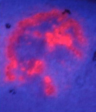 obraz zmiany nowotworowej po aplikacji estru kwasu lewulinowego, widziany w świetle o długości fali 410nm
