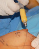 Program korekcji piersi autogennym przeszczepem tkanki tłuszczowej wspomaganym ekspansją tkankową systemem BRAVA