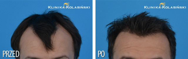 Przeszczep włosów - zdjęcia przed i po - Liczba przeszczepionych zespołów mieszkowych: 1000 FUE