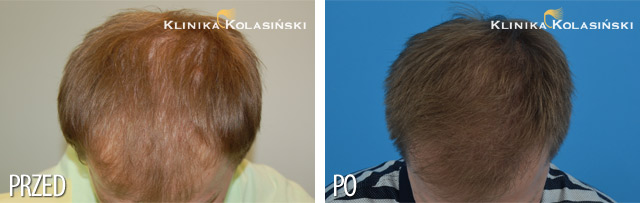 Przeszczep włosów - zdjęcia przed i po - Liczba przeszczepionych zespołów mieszkowych: 1500