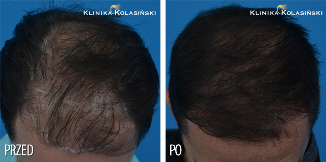 Przeszczep włosów - zdjęcia przed i po - Liczba przeszczepionych zespołów mieszkowych: 2500 FUE