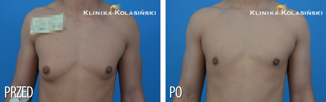 Klinika Kolasiński - zdjęcia przed i po