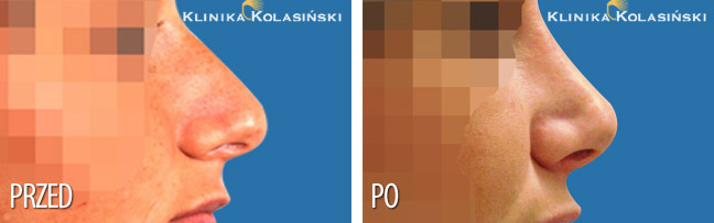 Klinika Kolasiński - Bilder vorher und nachher