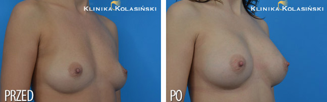Klinika Kolasiński - Before & after pictures