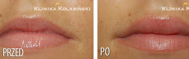 Klinika Kolasiński - zdjęcia przed i po