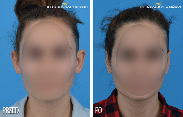 Pictures before and after: Ear correction
