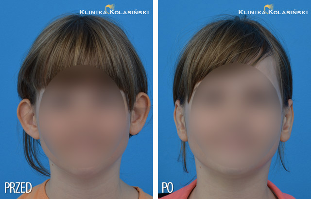 Zdjęcia przed i po zabiegu: korekcji uszu