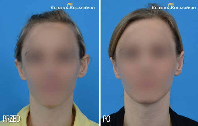 Bilder vorher und nachher: Ohrenkorrektur