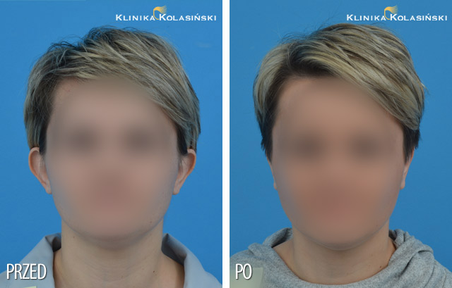 Pictures before and after: Ear correction