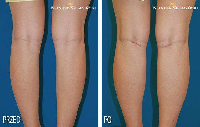 Zdjęcia przed i po: Korekcja łydek